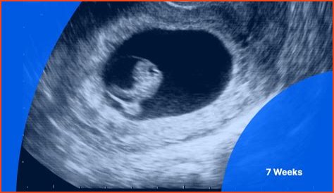 What is the reason of no heartbeat at 8 weeks?